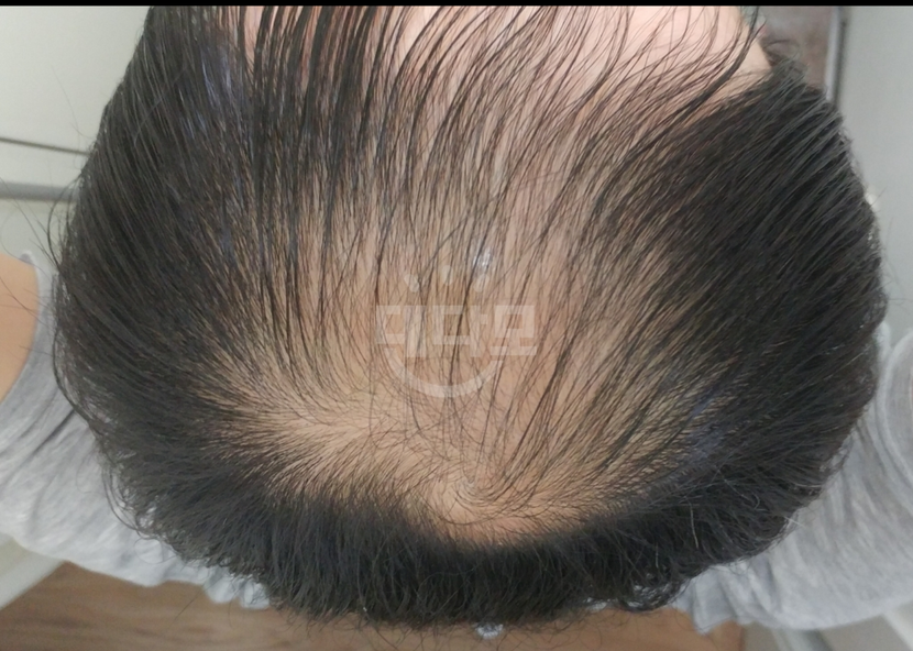 치료전 정수리