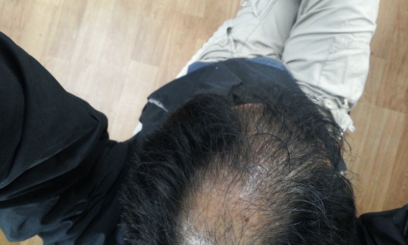 발모팩과 발모차 3달 사용 후기입니다