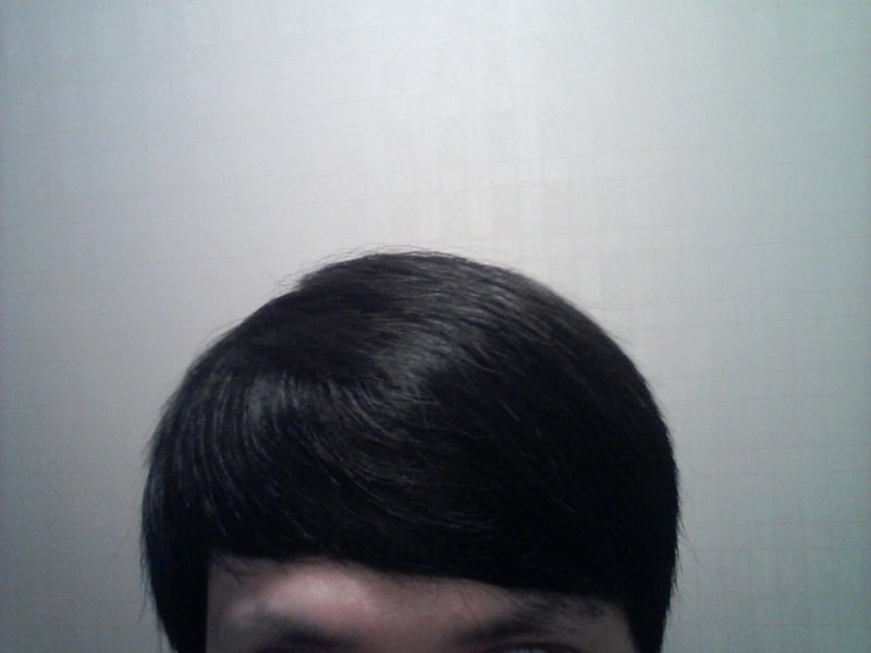 Finasteride（仿制药）第11个月。