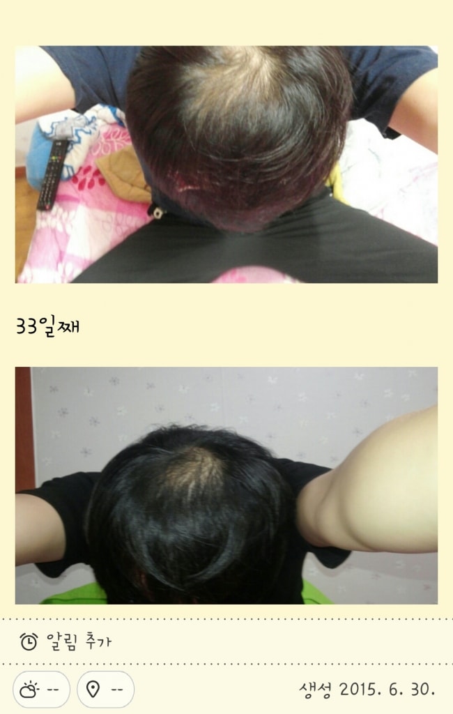 피나스테리드7개월 + 아보다트 1개월 + 미녹시딜 2통째입니다. day261