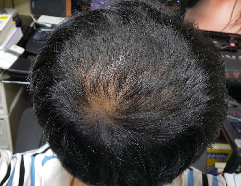 탈모치료 3달
