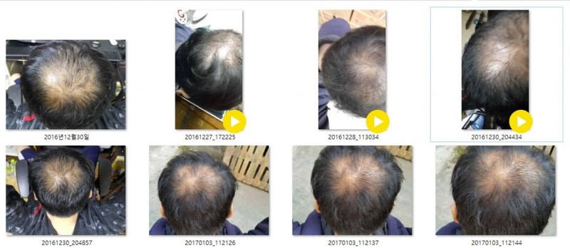 It's effective to take hair loss medicine for just 2 months.