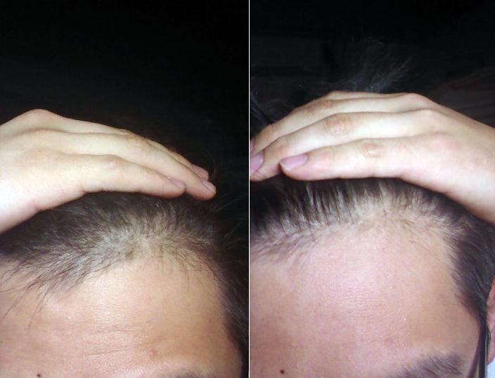 미녹시딜 8개월 사용 → 1개월 중지