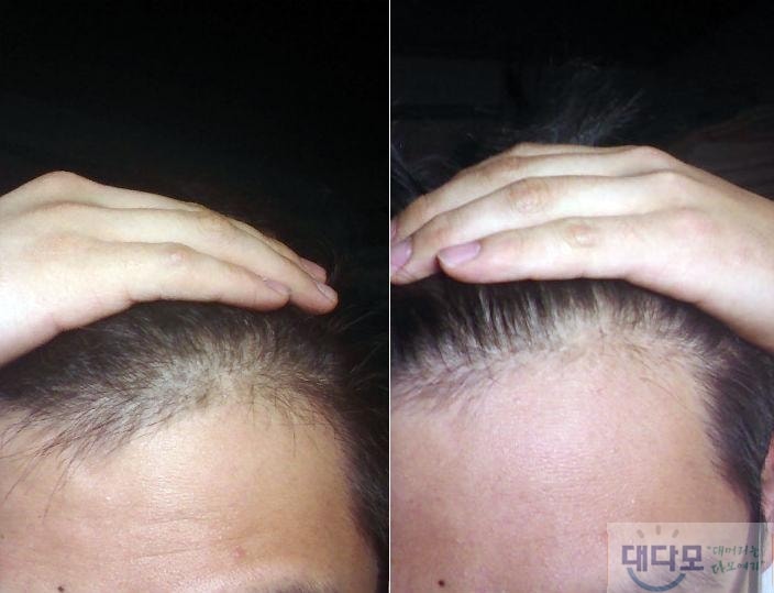 아보다트 75알 복용 전후