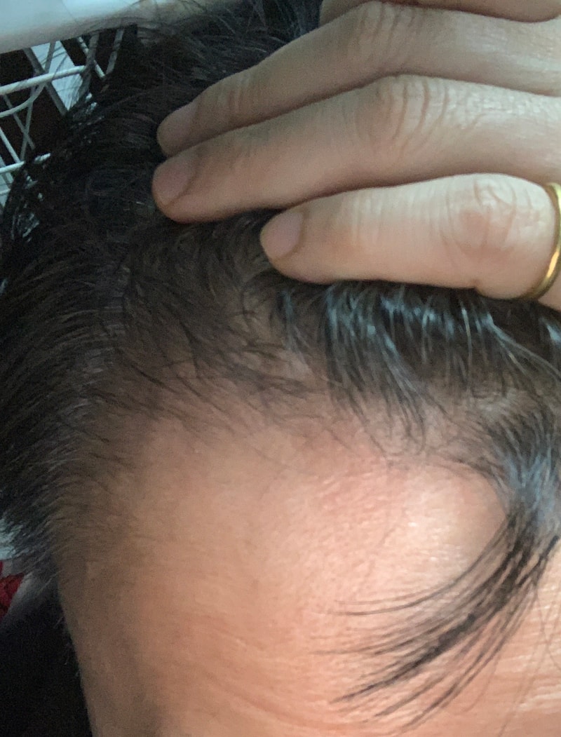 미녹시딜 5개월 사용후기