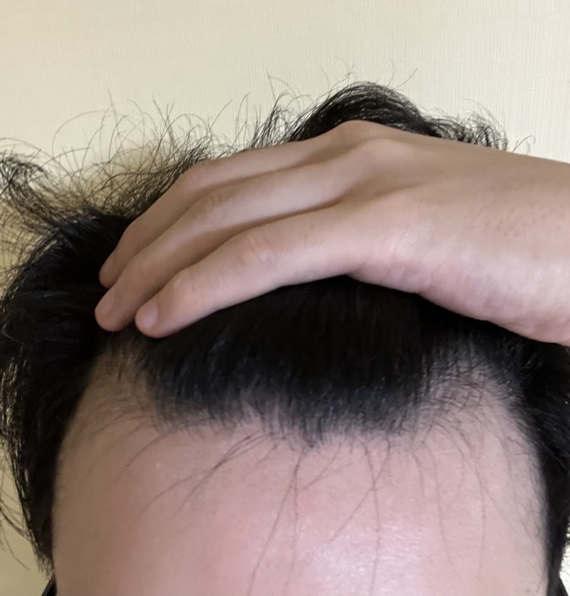 아보다트 복용 1년차 변화입니다.