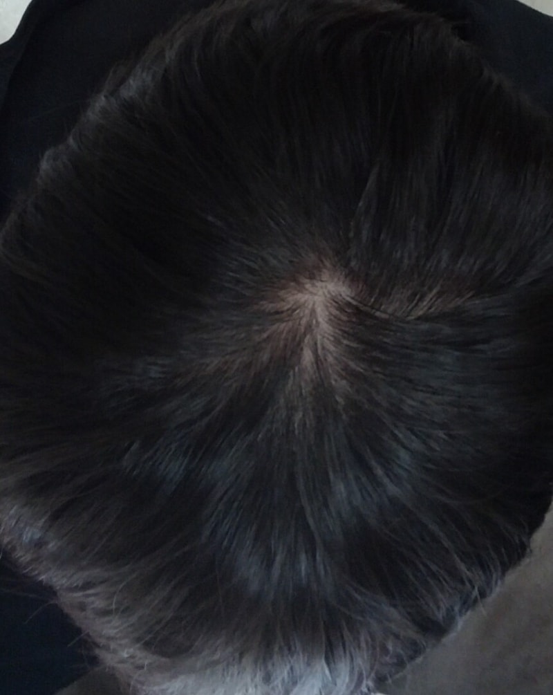 Proscageneric第4个月后期