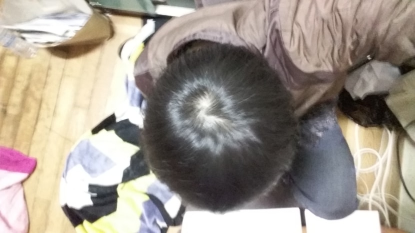 복용6개월반, 이식 3개월 정수리