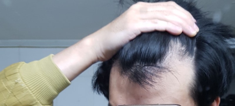 Propecia+Minoxidil 3个月期间经过