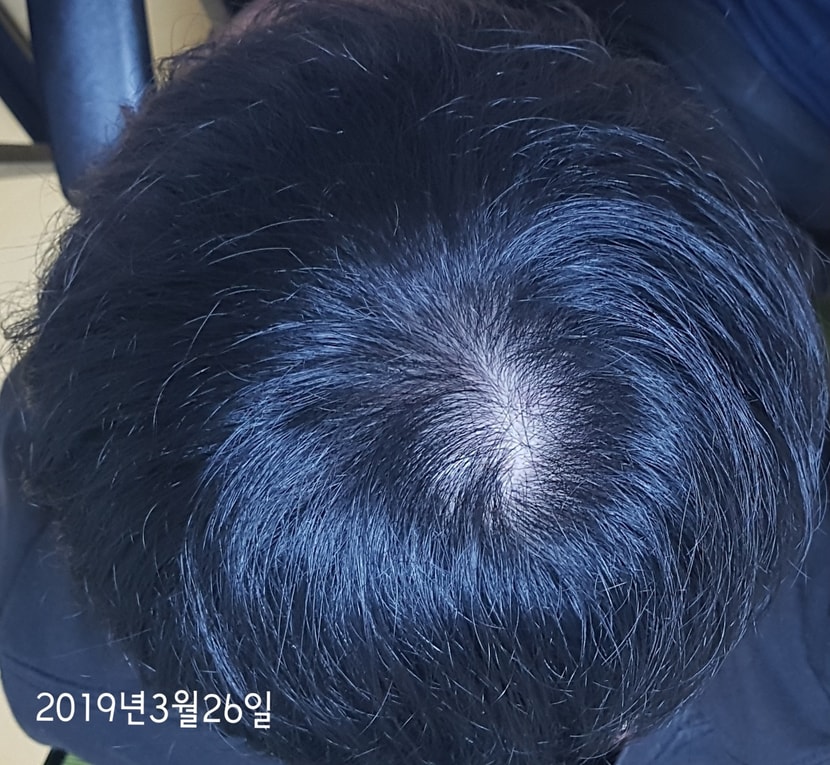 약복용 후 6개월이 지난 후입니다.