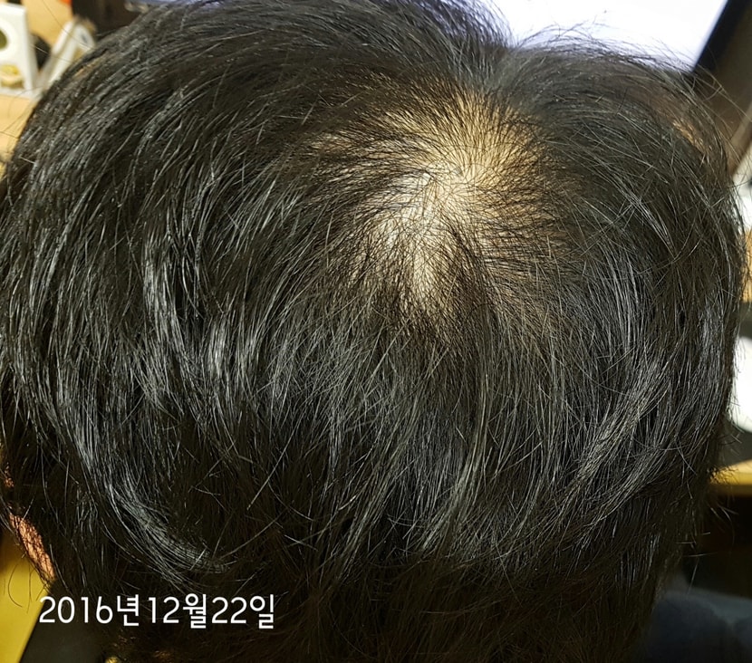 고등학생 시절 약처방은 안하고 탈모샴푸만 썼던 때입니다