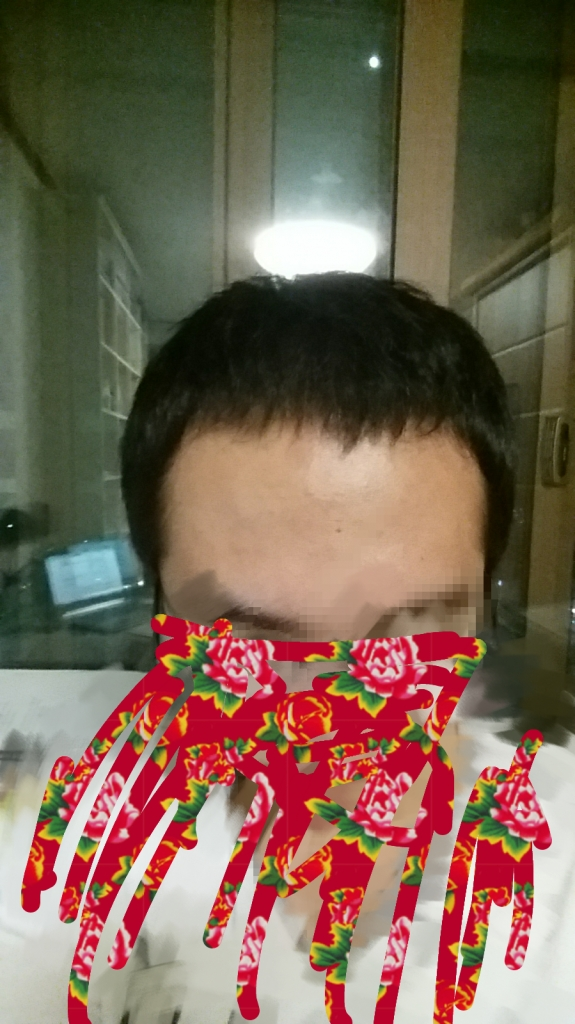 최근 약 복용 10개월 정도 후