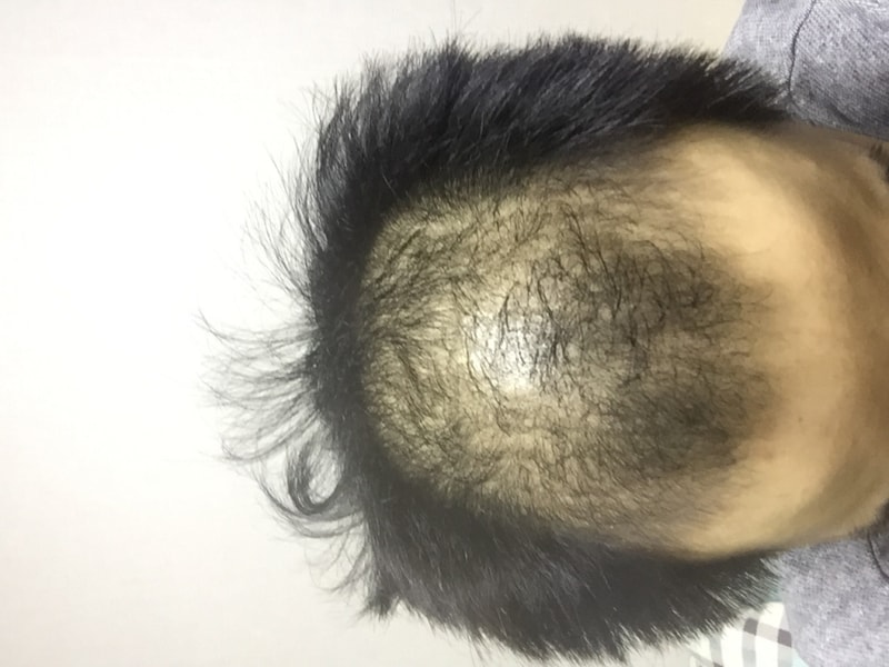 Abodat + Minoxidil 5个月后期