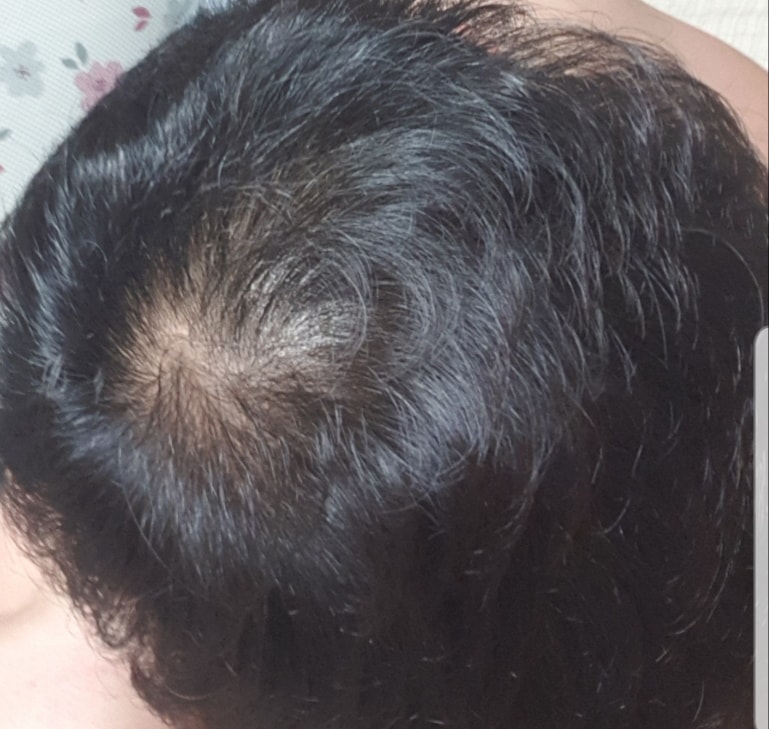 非那雄胺+米诺西地尔3个月第2周后期