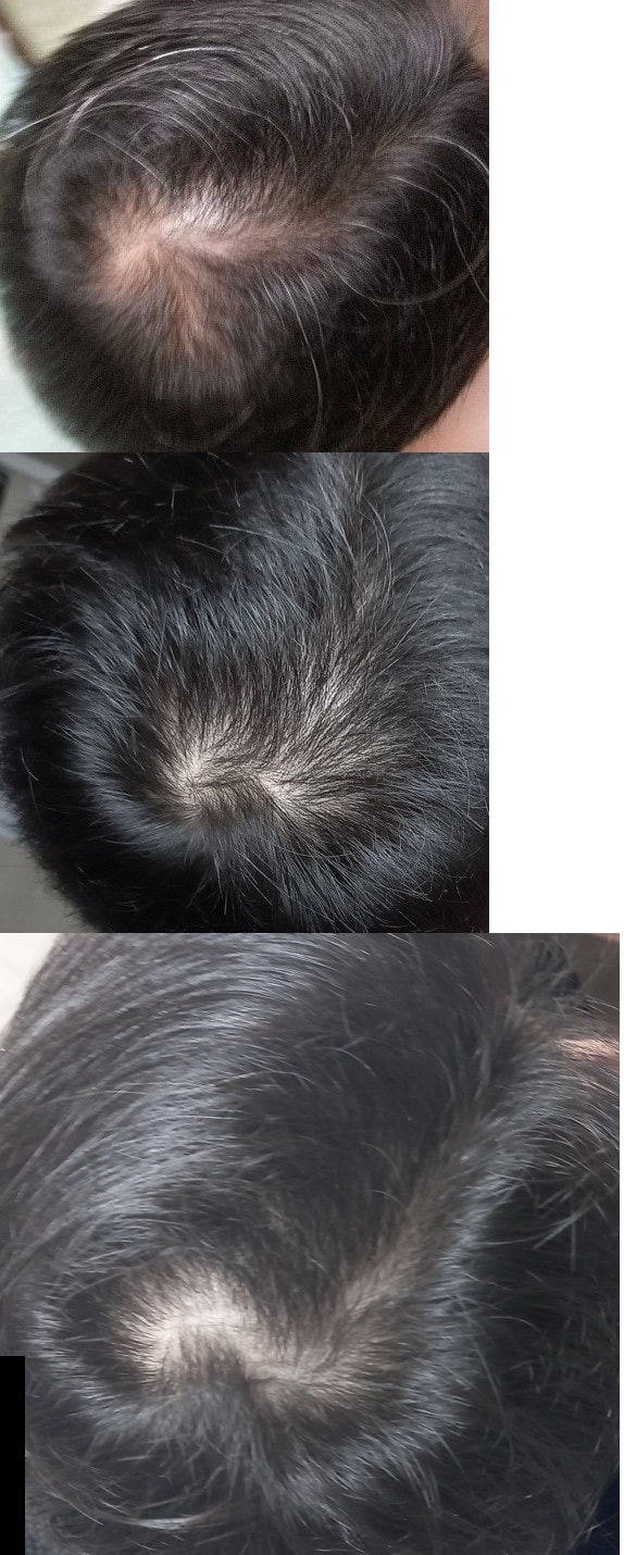 ピナ3年服用後の体験談