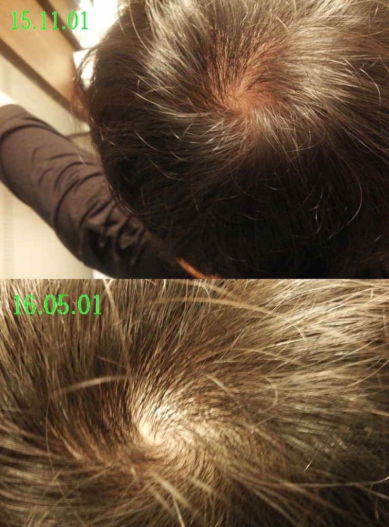 프로스카 1/4등분 6개월복용 간략한 후기입니다.