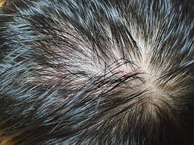 알로피나 2개월차