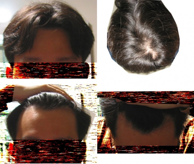 2월 14일.... 프카 복용 이전의 사진인데요....