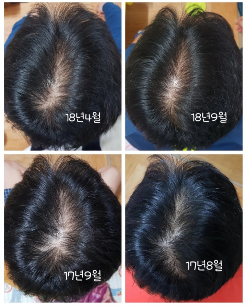 米诺地尔1年使用后记