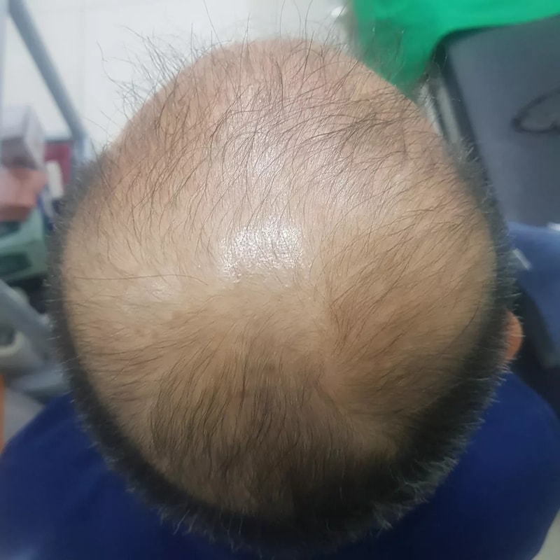 4~5개월 치료결과 입니다(바르는 병원약 + 복합약)