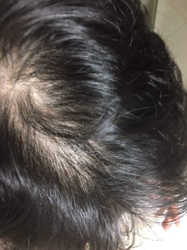 不吃药只涂米诺3~4个月地后记