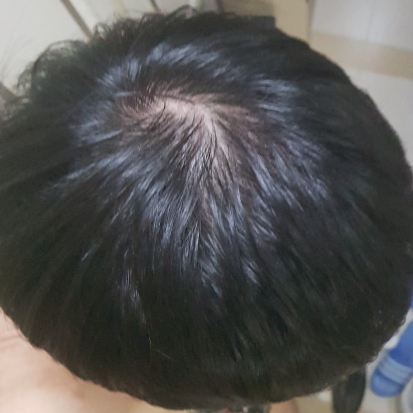 이 사진두 복용직전