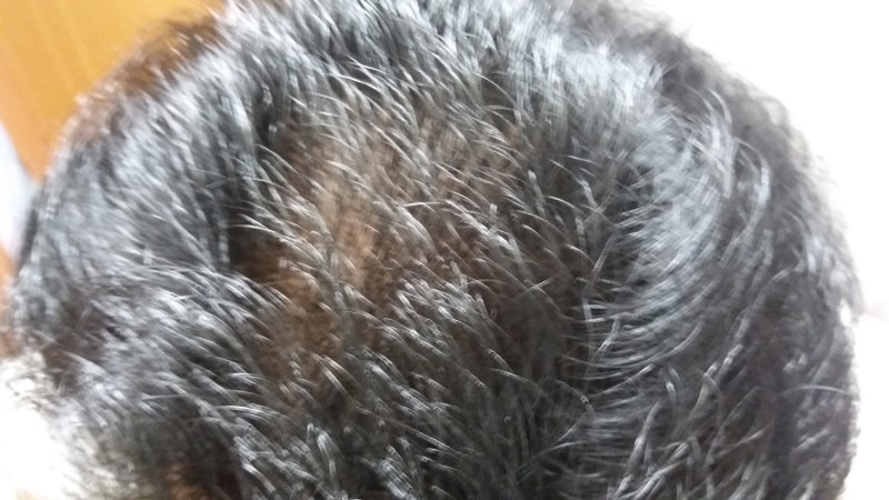 프카+미녹 100일차 인증 (복합성탈모 ㅠㅠ)