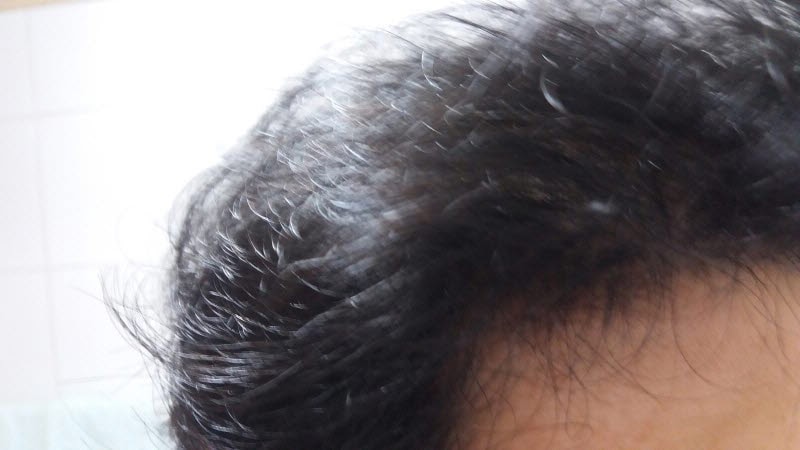 9월 m자 머리감기전 지루성많이 사라짐