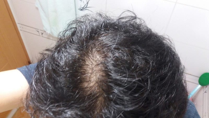 9월 머리 감기전 정수리 지루성 사라짐