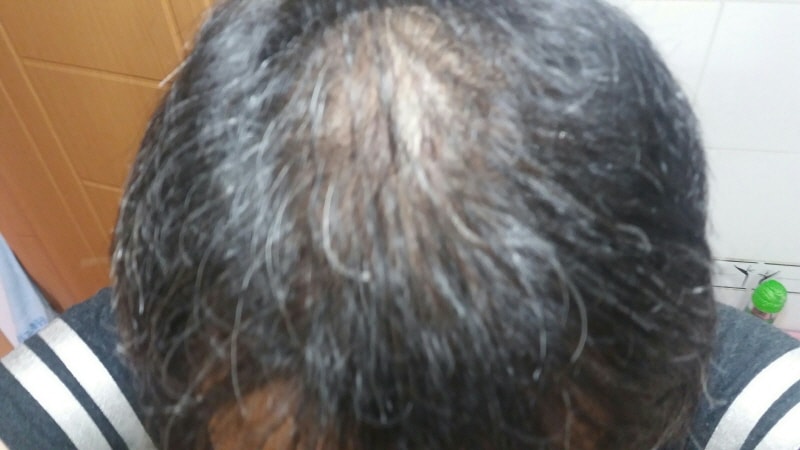 6월 머리 앞으로 빗은후 정수리