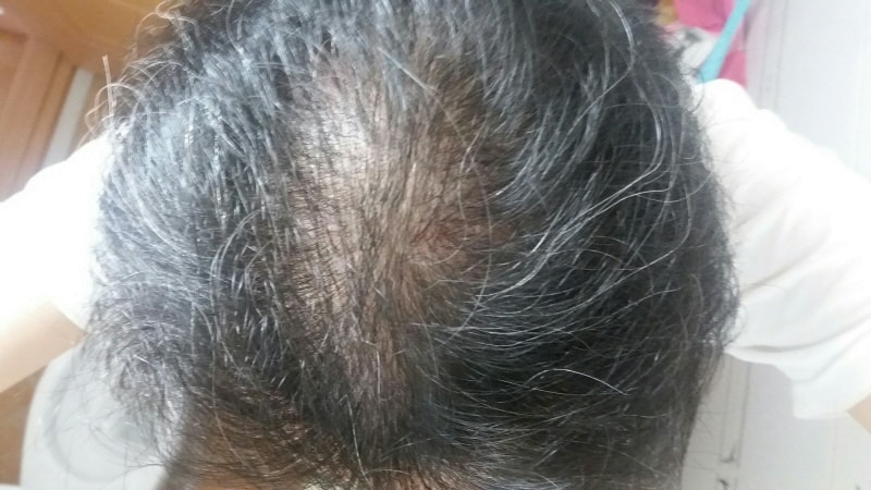 6월 머리 감은후 정수리