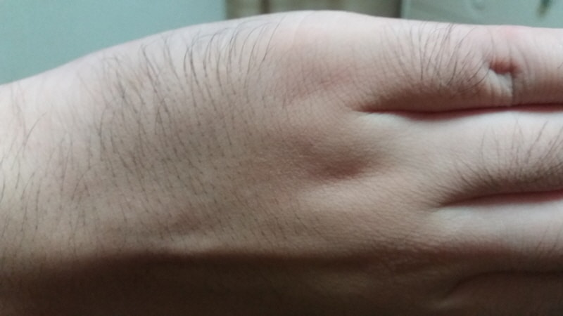 부작용 손등 손가락 마디 엄청 털이 길어짐