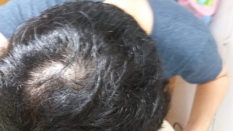 9월 머리 감기전 정수리 지루성 사라짐