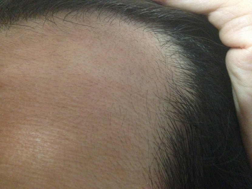 복용 24일째, 더 길고 굵어졌습니다. 아직 가까이서 보지 않으면 잘 보이는 정도는 아닙니다. 위보다 옆쪽이 더 빠르게 굵어지는것 같습니다. 잔털이 올라오는 위치(예전 탈모 일어난 장소)를 파악하게 되서 초점거리가 더 잘맞게 그쪽으로 카메라를 옮겼습니다. 그덕에 정면에서 찍을 때보다 이마선 후퇴가 어느정도 진행했었는지 확 체감이 오네요. 