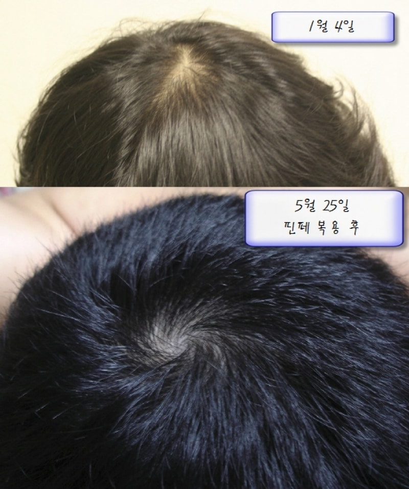 핀페시아 복용 후 사진 (약 5개월)