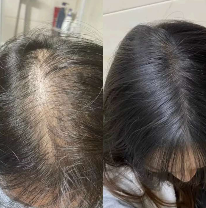 엘크라넬+로게인폼 후기!