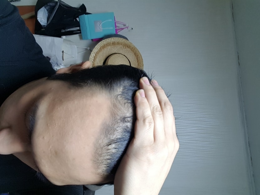 아보다트,미녹시딜 3개월