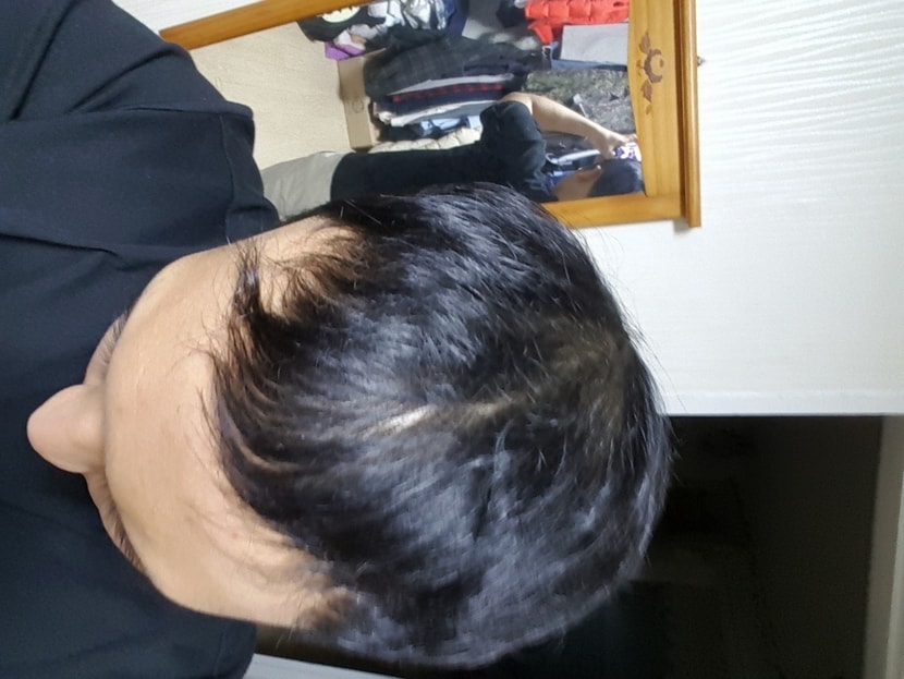 아보다트,미녹시딜 복용 전