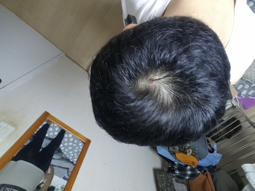 아보다트,미녹시딜 3개월