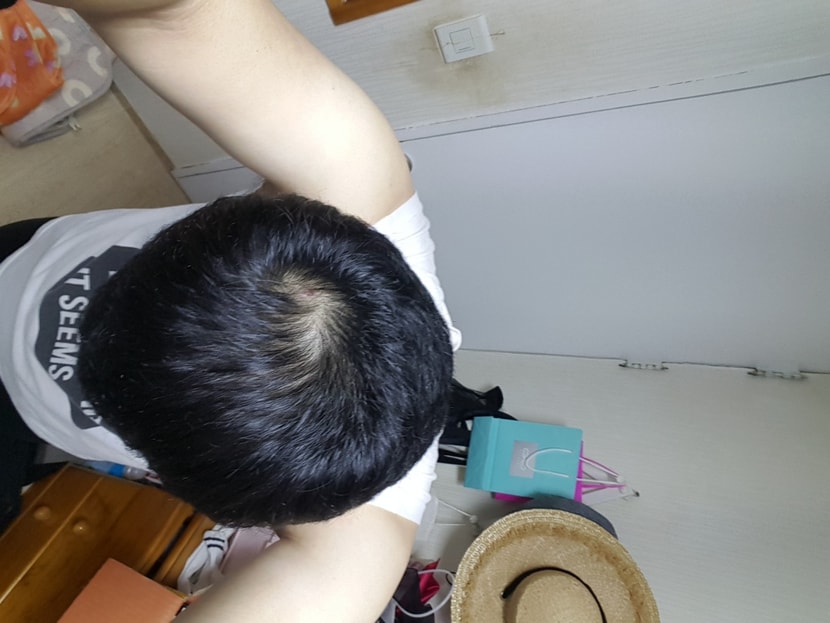 아보다트 복용 3개월