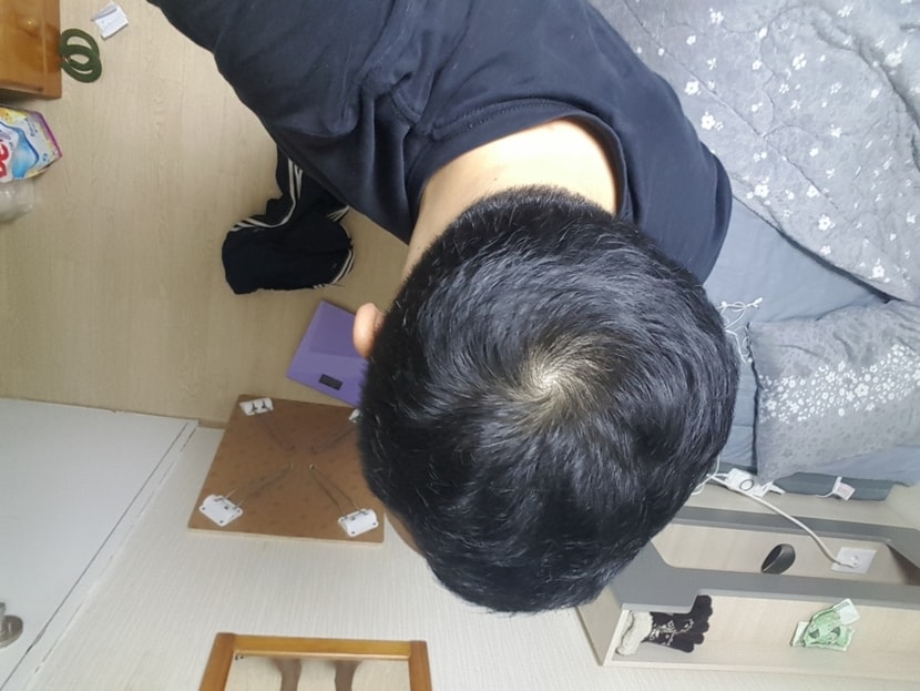아보다트,미녹시딜 4개월