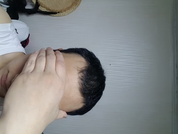 아보다트,미녹시딜 3개월