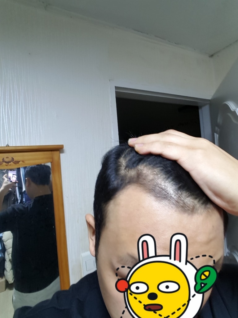 아보다트,미녹시딜 복용 전