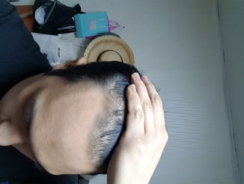 아보다트 복용 3개월