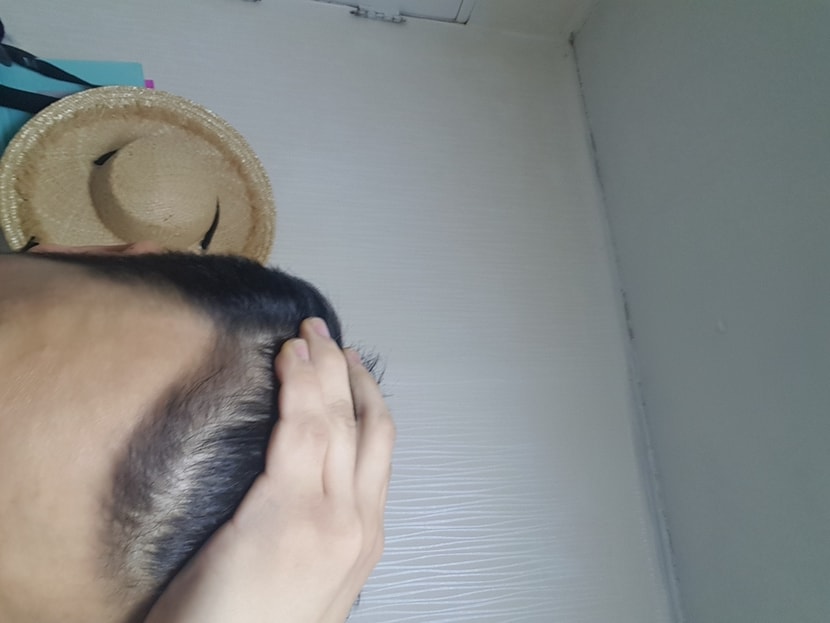 아보다트,미녹시딜 4개월