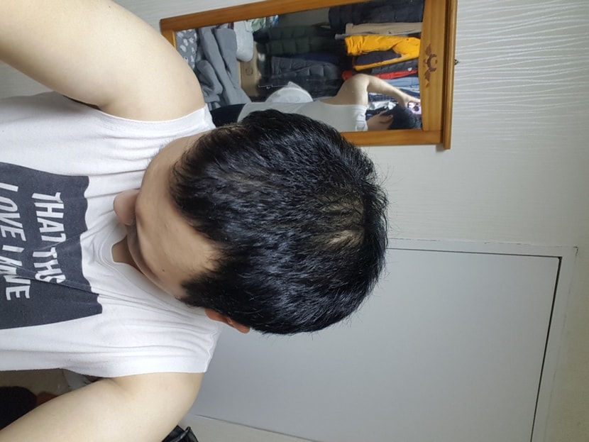 아보다트 복용 3개월
