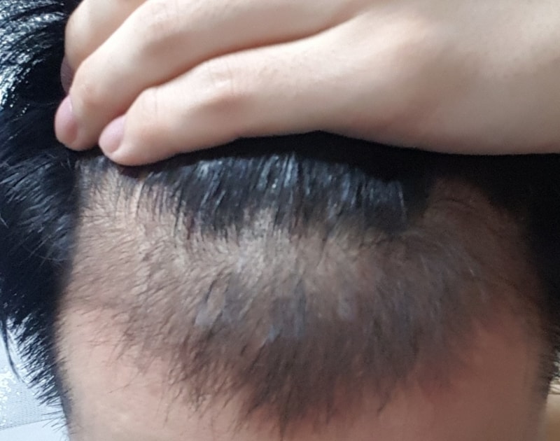 普罗斯卡170天后期