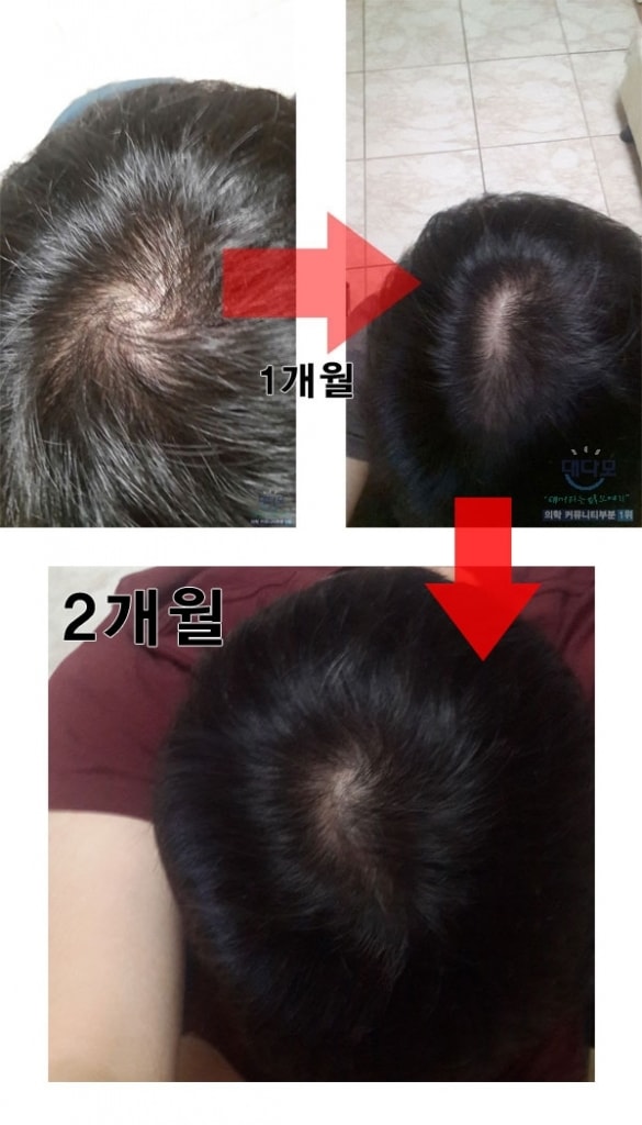 普鲁斯卡1/4，米诺西地尔下午1次涂抹，服药后8个月。