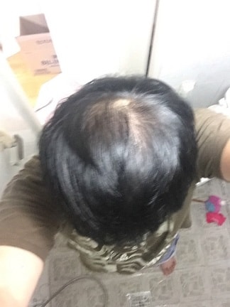 是服用Neodart6个月的后期。