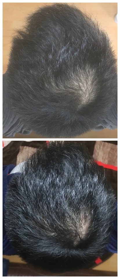 위가 미녹 바르기 전, 아래가 미녹 바른 후 3개월입니다